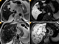 Рис. 1. Метастазы увеальной меланомы в печень: А (на Т2-ВИ) и Б (Т1-ВИ) с контрастным усилением, гепатобилиарная фаза – визуализируется единичный очаг в правой доле печени (стрелка); В (Т2-ВИ) и Г (Т1-ВИ) с контрастным усилением