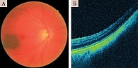 Рис. 1. Офтальмоскопия (A) и томограмма (Б) стационарного невуса хориоидеи