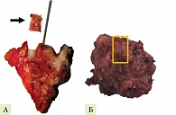 Рис. 3. Пример получения образца тканей из удаленного препарата: А – с новообразованием ПЖ, Б – при дренирующей операции по поводу ХП. Черной стрелкой и оранжевым контуром показаны изучаемые участки тканей