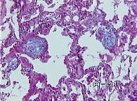 Рис. 3. Больной П.: врастание грануляционной ткани  в просвет альвеол в виде полипов. Окраска альциановым синим. ×100.