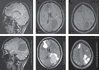 Рис. 1. МРТ головного мозга от 19 декабря 2017 г.