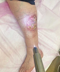 Рис. 2. Проведение процедуры НАП