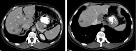 Рис. 3. Компьютерная томография органов брюшной полости пациентки Г. в динамике после 16 курсов лечения