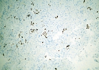 Рис. 3. ИГХ-исследование. Положительная экспрессия в опухолевых клетках с антителами к TTF-1. ×10