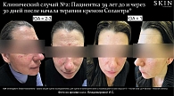 Рис. 10. Результат лечения пациентки кремом Солантра® через 30 дней терапии