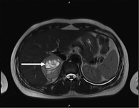 Рис. 1. Образование правого надпочечника на компьютерной томограмме в аксиальной плоскости, указано стрелкой
