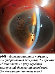 Рис. 2. Ранний послеоперационный период после комбинированной операции осложненной катаракты и глаукомы с имплантацией дренажа «Ксенопласт»