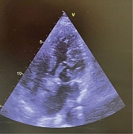 Рис. 5. Контрольная ЭхоКГ спустя год после кардиохирургического лечения. Опорное кольцо митрального клапана