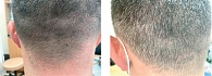 Рис. 3. Локализация: задняя поверхность шеи, до и через 14 дней после проведенной терапии