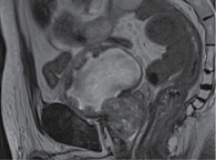 Рис. 5. МРТ-картина мультицентричного рецидива рака мочевого пузыря от августа 2021 г.