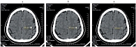 Рис. 1. Метастаз левой теменной области головного мозга: а – до лечения; б – через 2 месяца; в – через 4–12 месяцев лечения