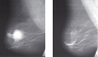 Рисунок 1. Больная К. до и после неоадъювантной  гормонотерапии эксеместаном