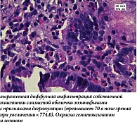 Рис. 2. Гистологическое исследование биоптатов ДПК:
