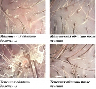 Рис. 6. Результаты трихоскопии пациента