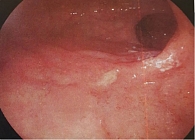 Рис. 4. Селективная ангиография левой наружной сонной артерии после химиоэмболизации: патологическая сосудистая сеть не визуализируется