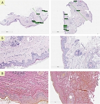 Рис. 3. Гистологическая картина у пациентки С. до и после лазерной терапии (А, Б – окрашивание ГЭ, В – окрашивание по В-Г)