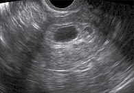Рис. 3. В полости матки визуализируется плодное яйцо. Заключение: неполный аборт (наблюдение и фото автора)