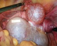 Рис. 7. Пациентка В., 13 лет: интраоперационная картина после деторсии правых придатков матки. Визуализируется лимфостаз в проекции правого яичника