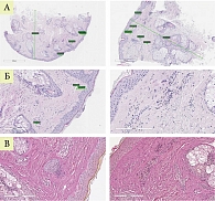 Рис. 7. Гистологическая картина у пациентки Т. до и после лазерной терапии (А, Б – ГЭ, В – В-Г)