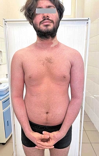 Рис. 4. Состояние при поступлении пациента Т., 21 год, диагноз «псориатическая эритродермия и псориатический артрит»