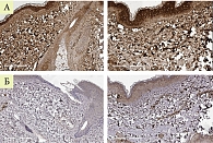 Рис. 10. Иммуногистохимическое исследование у пациентки Ш. до и после лазерной терапии  (А – коллаген I типа, Б – коллаген III типа)