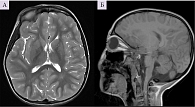 Рис. 1. Магнитно-резонансная томограмма пациентки в возрасте семи лет: аксиальное изображение в режиме Т2 (А), сагиттальное изображение в режиме Т1, на котором выявляется уменьшение объема мозжечка (Б)