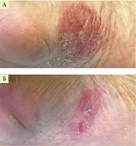 Рис. 1. Пациент Н., 42 года, с микробной экземой до (А) и через десять дней после терапии кремом Акридерм ГК (Б)