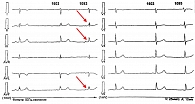 Рис. 1. Пример фрагментации QRS синусового комплекса в отведениях, соответствующих нижней стенке левого желудочка (стрелками указана FQRS в отведениях II, III, AVF у пациентки М. 34 лет с сочетанием воспалительных и фиброзных изменений по данным ЭМБ)