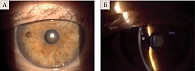 Рис. 1. Биомикроскопия правого глаза в фокальном (А) и диффузном (Б) освещении в день поступления