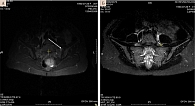 Рис. 4. Магнитно-резонансная томограмма КПС пациентки Б. в режиме STIR в марте 2021 г. (А) (стрелка указывает на активный остеит в левом суставе) и через год (Б) (признаки остеита отсутствуют)