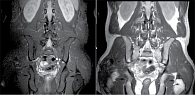 Рис. 7. Магнитно-резонансная томограмма КПС пациента И. в режиме Т2 через три месяца (прослеживаются признаки усиления жировой дегенерации, несмотря на полный регресс активного воспаления (остеита) в режиме жироподавления)