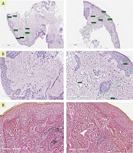 Рис. 13. Гистологическая картина у пациентки С. до и после лазерной терапии (А, Б – ГЭ, В – В-Г)