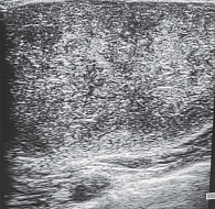 Рис. 5. Эхограмма гигантской ювенильной фиброаденомы левой молочной железы у 13-летней девочки