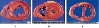 Рисунок 1. Различные типы геометрии левого желудочка:  а – норма; б – концентрическая ГЛЖ; в – эксцентрическая ГЛЖ