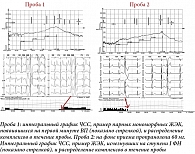 Рис. 2. Фрагмент ТТ пациентки Т. 54 лет