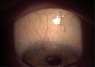 Рис. 3. Состояние правого глазного яблока перед проведением хирургического вмешательства
