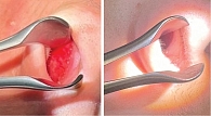Эндоскопическая картина полости носа до (А) и после (Б) терапии средством для слизистой оболочки Висколор® на фоне проявлений субатрофического ринита