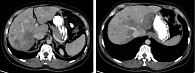 Рис. 2. Компьютерная томография органов брюшной полости пациентки Г. в динамике через три месяца после начала лекарственного лечения  (три курса терапии)