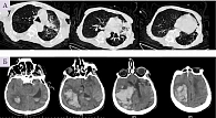 Рис. 2. Компьютерная томограмма легких (А) и головного мозга (Б) у пациента 79 лет с подтвержденным диагнозом COVID-19