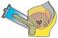 Рис. 1. Вакуумное устройство, создающее отрицательное давление в области полового члена