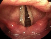 Рис. 2. Ларингоскопия, осмотр и заключение профессора К.И. Нестеровой: утолщение голосовых складок, неравномерность окраски, гиперемия и отек голосовых складок