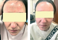 Рис. 2. Локализация: кожа лица, до и через 14 дней после проведенной терапии