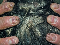 Рис. 9. Пациент Л., 59 лет, диагноз «псориатическая эритродермия, псориатические бляшки, алопеция кожи волосистой части головы»