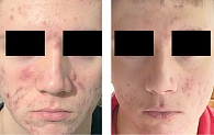 Рис. 1. Результаты лечения acne vulgaris у пациента 18 лет (период наблюдения – восемь недель)