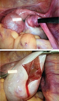 Рис. 6. Пациентка В., 13 лет: интраоперационная картина мягкого (нетугого) перекрута правых придатков матки