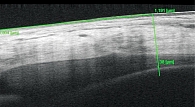 Рис. 4. Пациентка С.: толщина сосудистого слоя цилиарного тела левого глаза в наружном отделе на 3 часах на 31-й неделе беременности