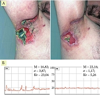 Рис. 6. Пациент  Л.: А – до и после проведения комплексной терапии с применением 10 процедур НАП; Б – лазерная допплеровская флоуметрия микроциркуляции того же пациента до и после 10 процедур НАП