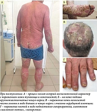 Рис. 5. Состояние при поступлении пациента С., 66 лет, диагноз «псориатическая эритродермия и псориатический артрит, ВИЧ-инфекция».