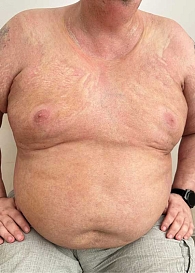 Рис. 5. Пансклеротическая склеродермия. Тотальная индурация кожи туловища