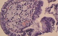 Рис. 12. Пенистые клетки в подслизистом слое стенки желчного пузыря